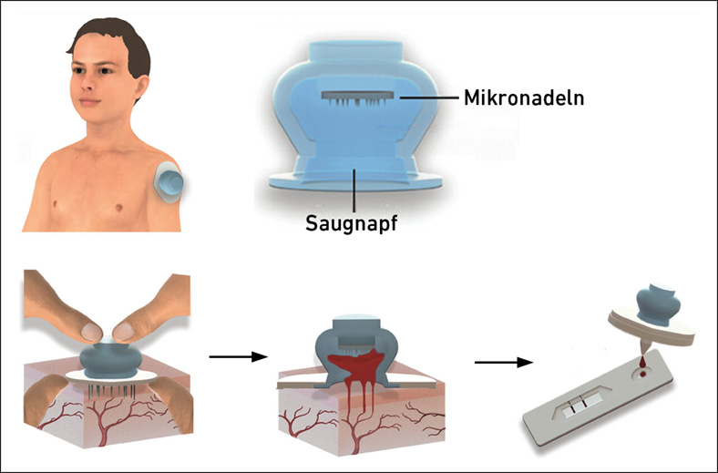 Vergrösserte Ansicht: Darstellung des Saugnapfs und seiner Anwendung. Mikronadeln innerhalb des Saugnapfs sind erkennbar, welche das Blut aufnehmen, das anschliessend auf einen Teststreifen getröpfelt wird.