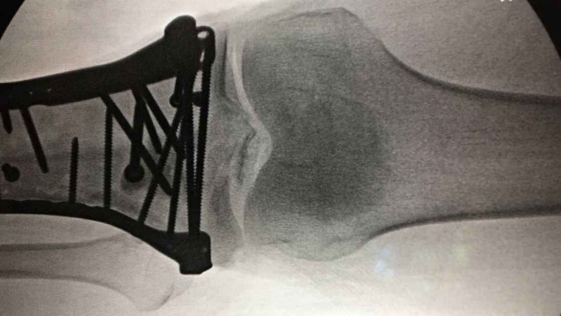 Vergrösserte Ansicht: Röntgenbild eines Schienbeinbruchs direkt unterhalb des Kniegelenks: Solch komplizierten Verschraubungen sollen vereinfacht werden. (Bild zVg T. Zumbrunn)