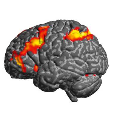 Magnetresonanz-Tomografie des Gehirns, gewisse Stellen sind grau, andere gelb bis dunkel orange.