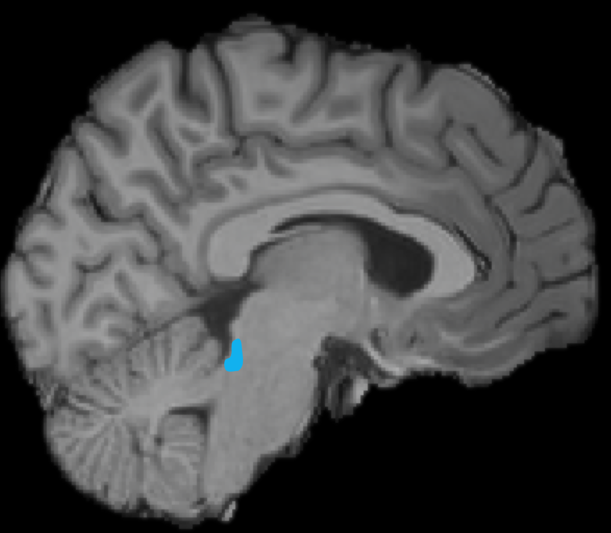 Vergrösserte Ansicht: MRI von einem Gehirn, eine kleine Fläche (in der unteren Hirnhälfte in der Mitte) ist blau markiert