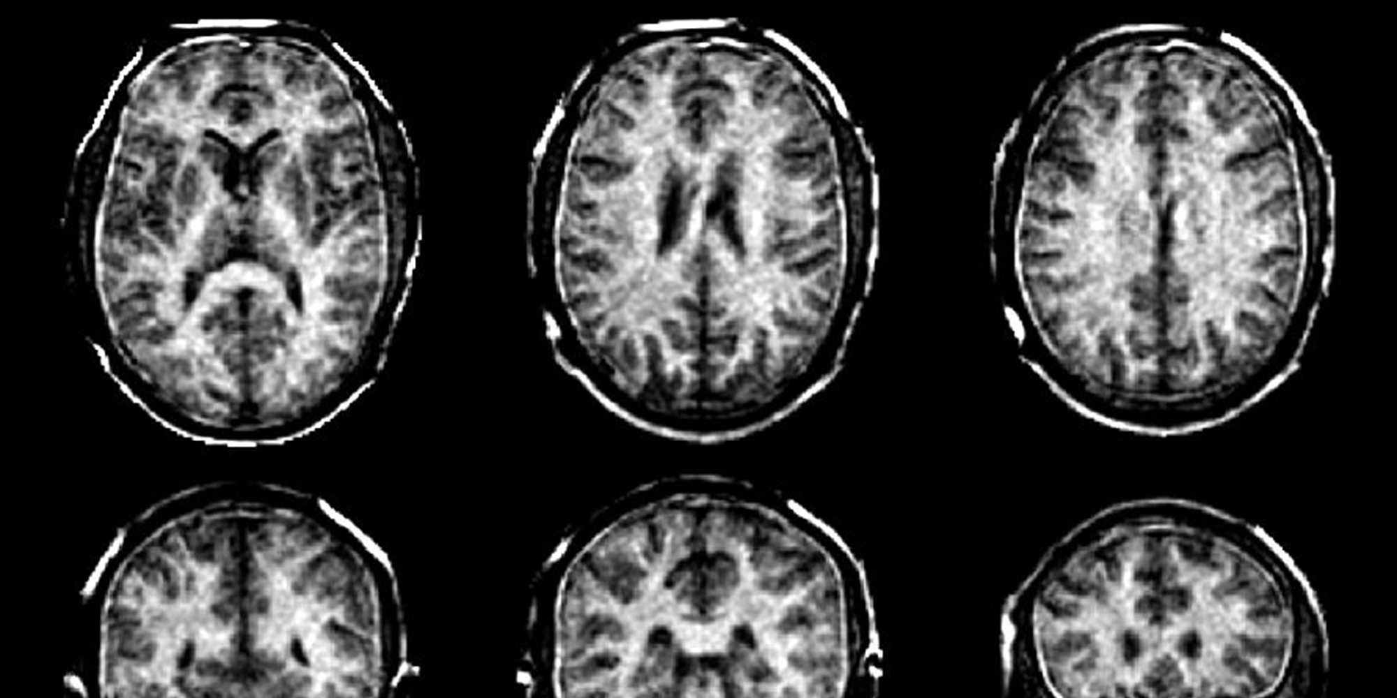 MRT Scan des Gehirns