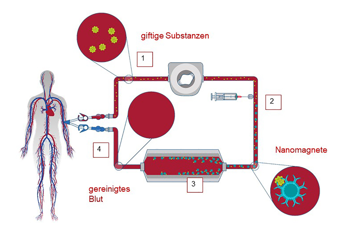 Illustration zeigt, wie die Blutreinigung ausserhalb des Körpers funktioniert