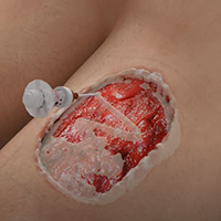 illustration of an open wound