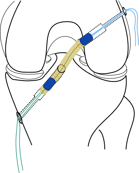 Enlarged view: Schematic drawing of the new knee implant. (Illustration: courtesy of Prof. Jess G. Snedeker)