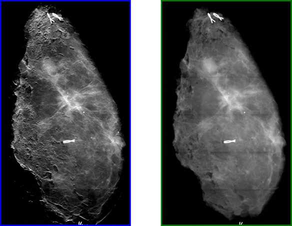 Mammography images