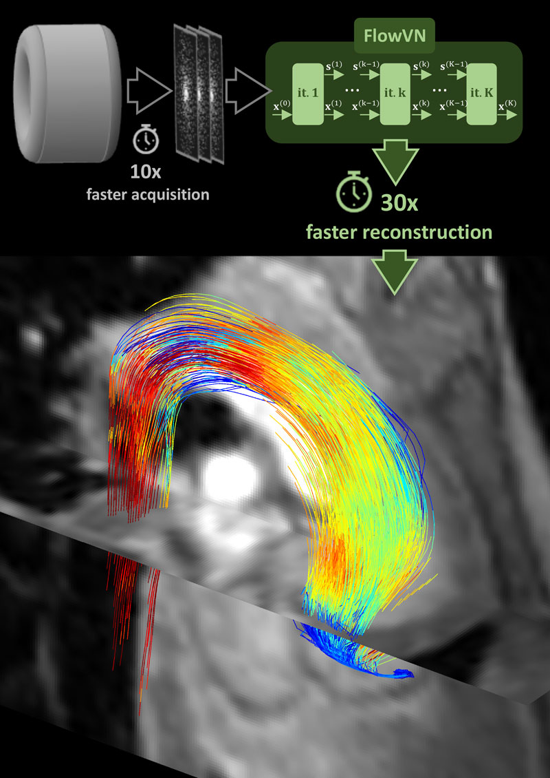 Enlarged view: The new MRI method makes it possible to obtain precise MRI images of blood flow in less than five minutes instead of 30 minutes as it is currently the case. (Visualization: CMR Zurich)