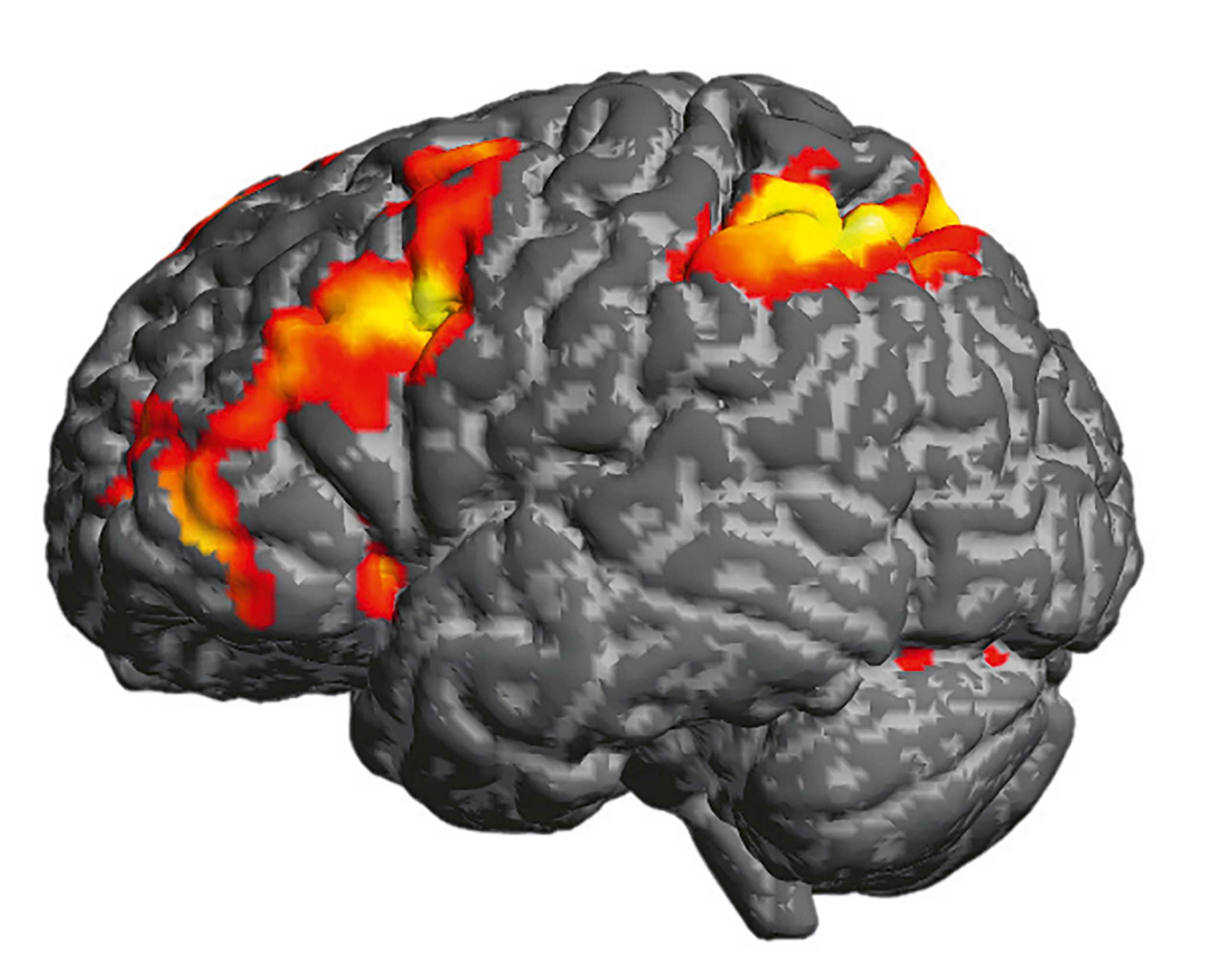Magnetic resonance imaging of the brain, certain areas are gray, others yellow to dark orange.