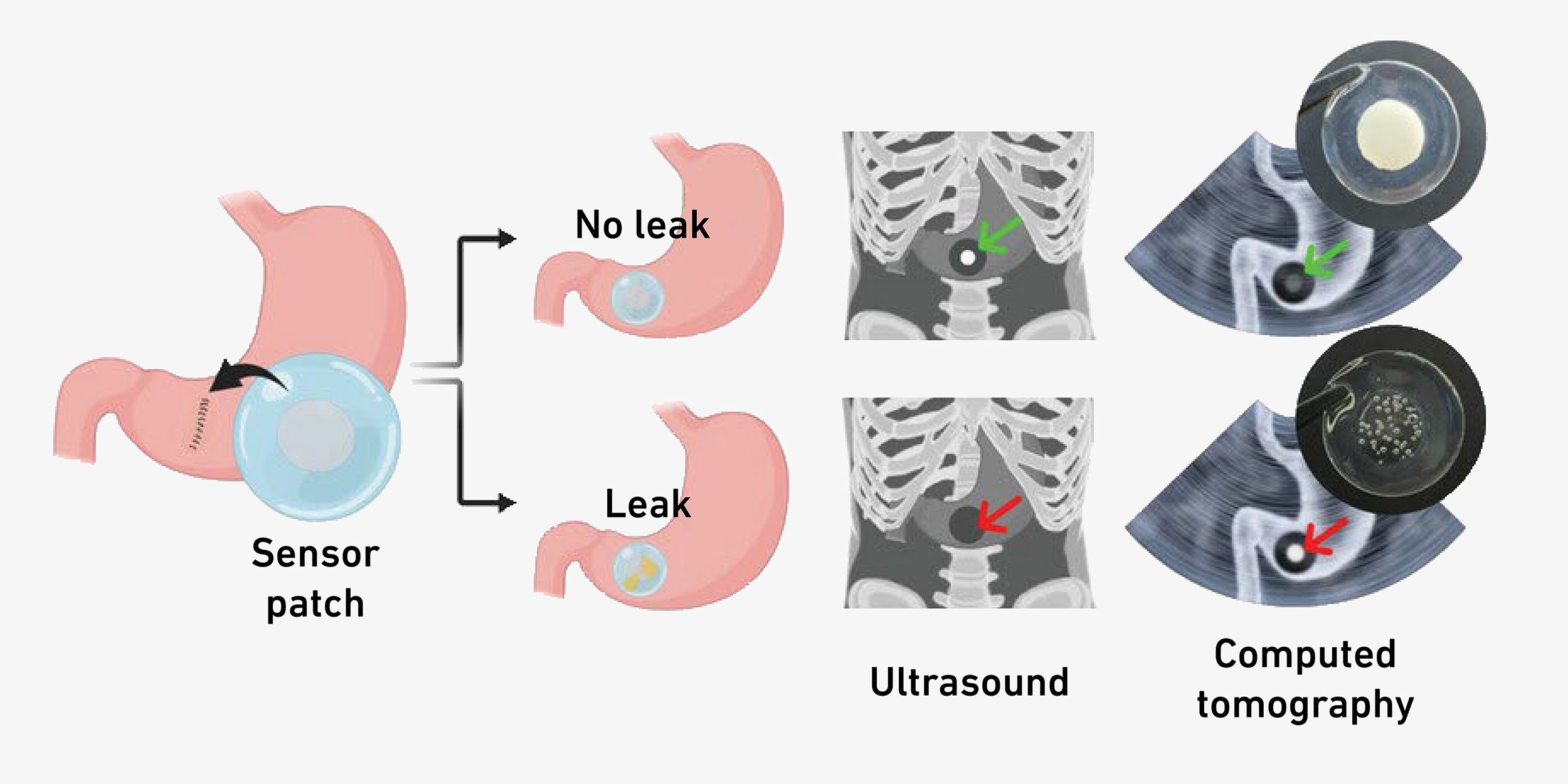 Enlarged view: Schematic representation of stomach with leak and stomach without leak.