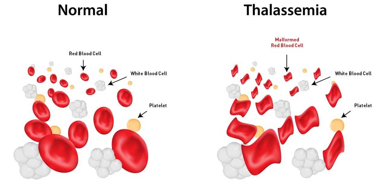 Enlarged view: The difference between the correctly functioning red blood cells and those with a malfunction.