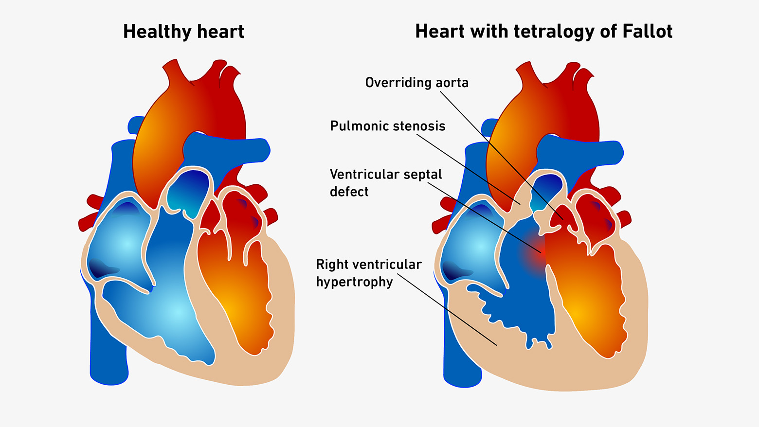 Enlarged view: Schematic representation of a healthy heart next to a heart with tetralogy of Fallot, in which the dividing wall between the two heart chambers has a hole.