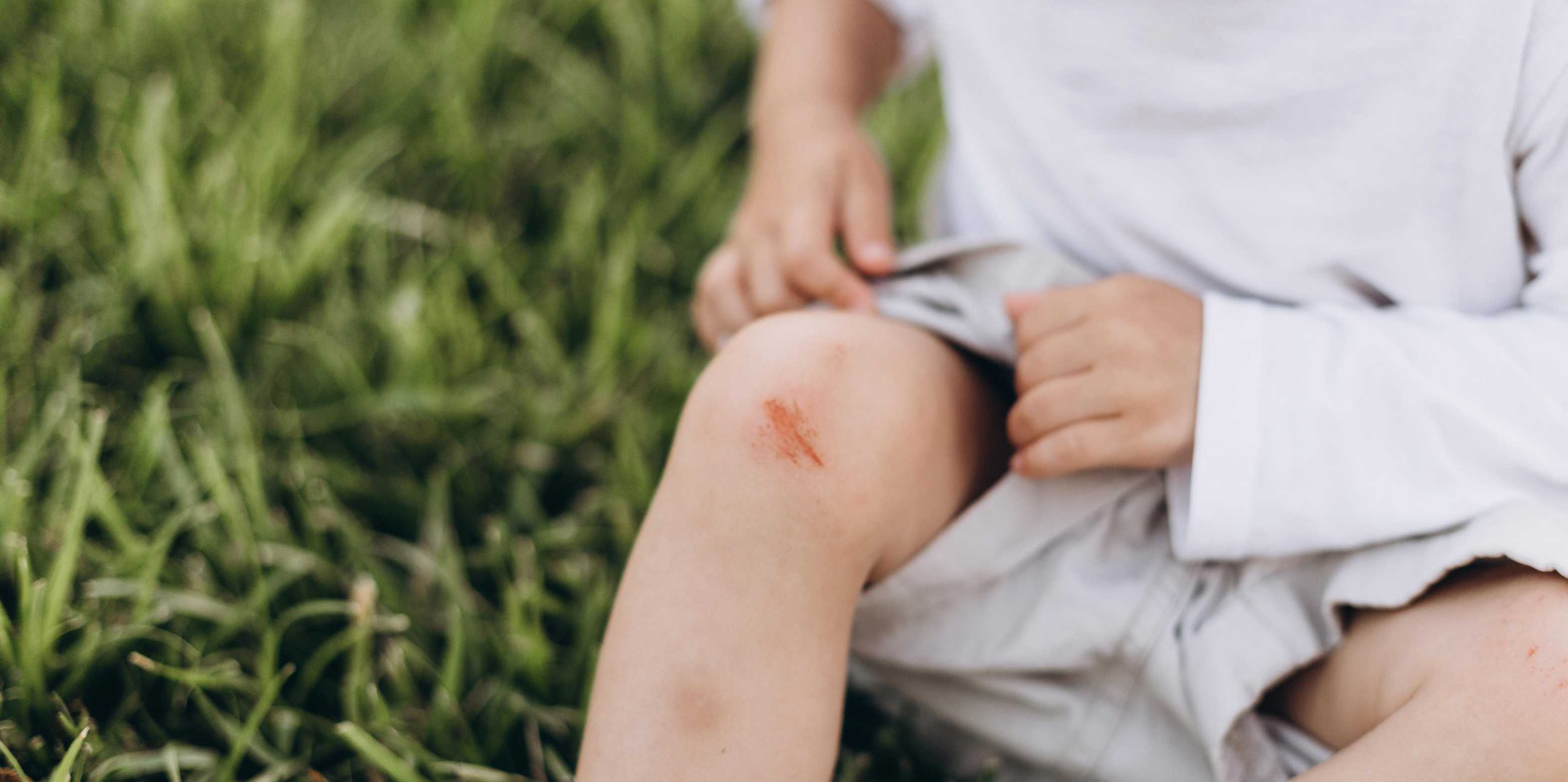 Child with an abrasion on his knee. It is sitting in the grass. 