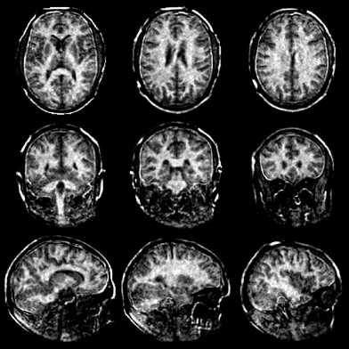 MRT scan of the brain
