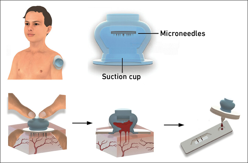 Enlarged view: Illustration of the suction cup and its application. Microneedles can be seen inside the suction cup, which absorb the blood, which is then dripped onto a test strip.