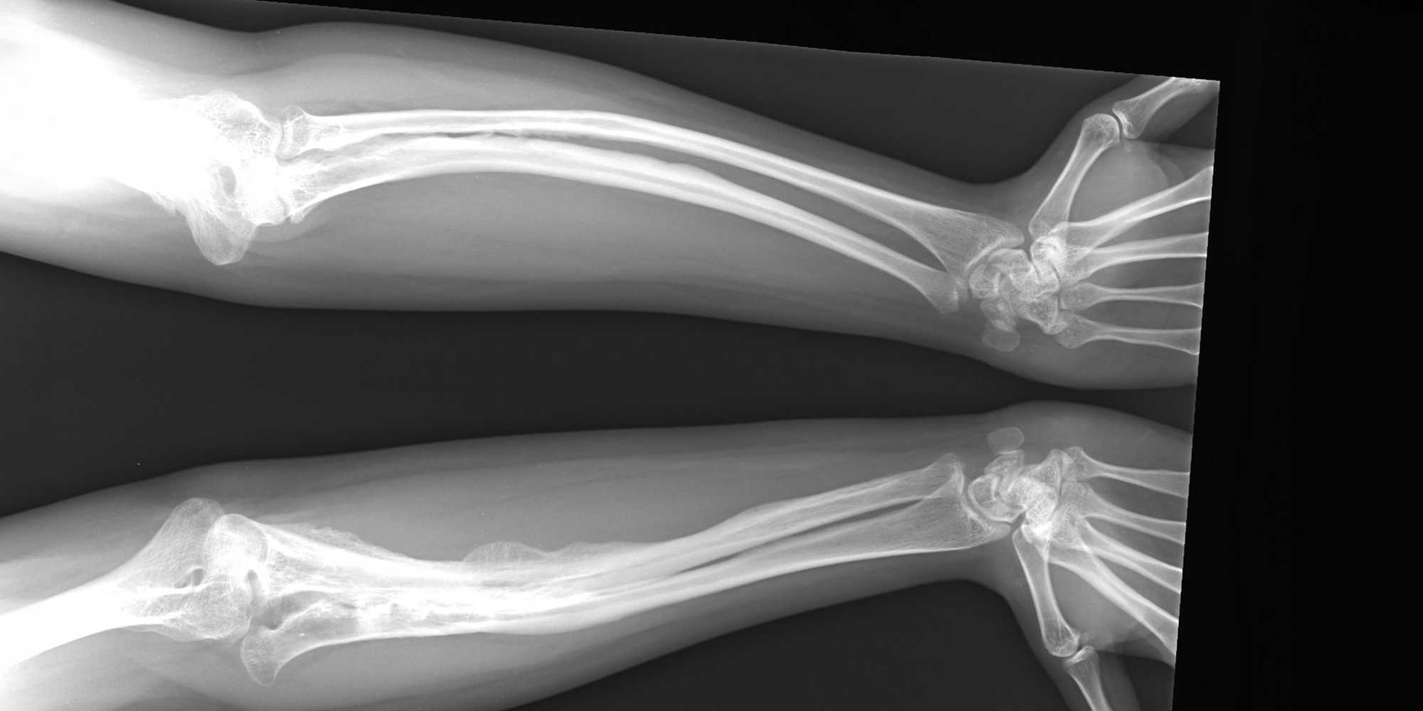X-ray images of both arms