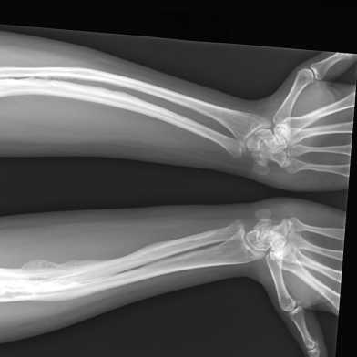 X-ray of both arms