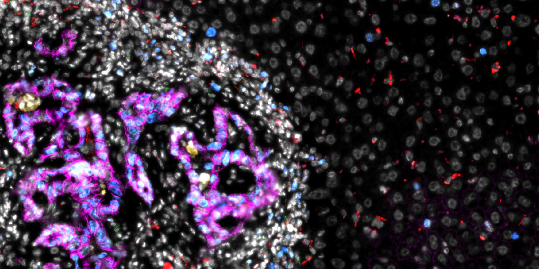 Microscopy image of a colorectal cancer metastasis