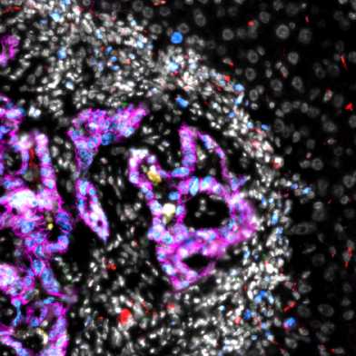 Microscopy image of a colorectal cancer metastasis